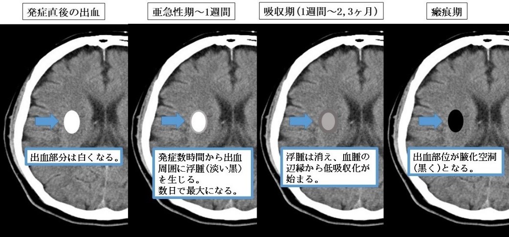 頭部CTの経時的変化
